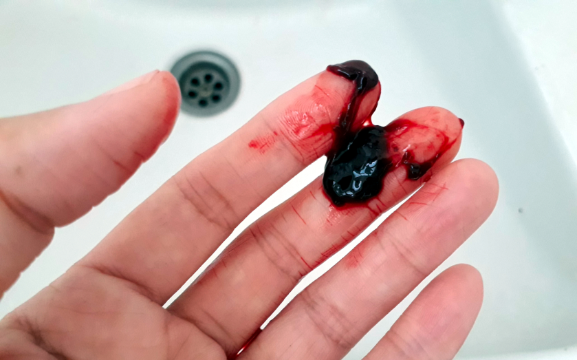 Passed a massive blood clot?? What is normal and what isn't? : r/Periods